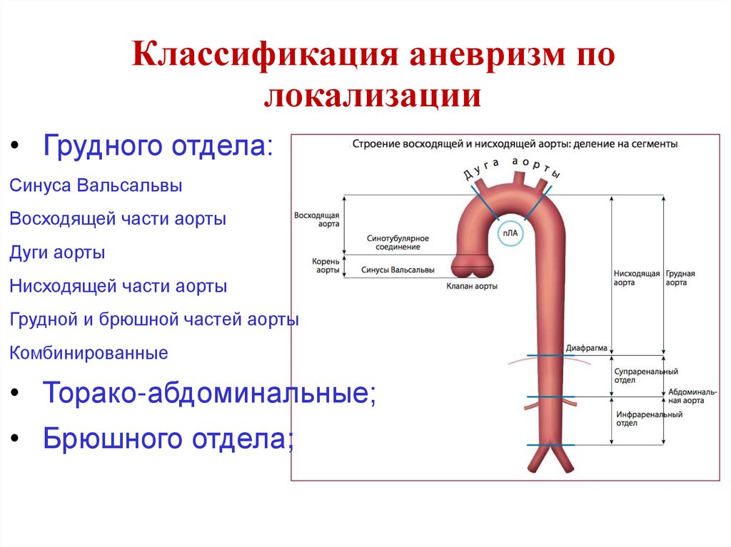 Классификация аневризм по локализации