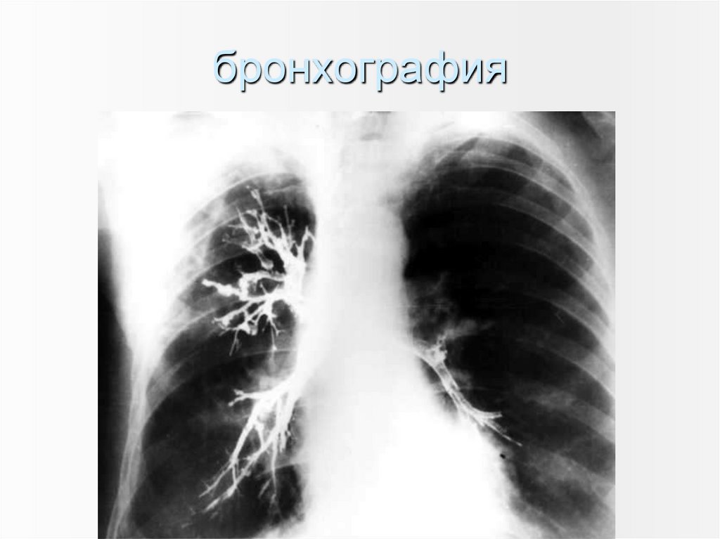 бронхография