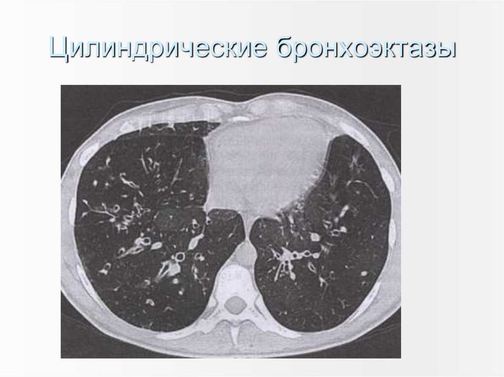 Цилиндрические бронхоэктазы