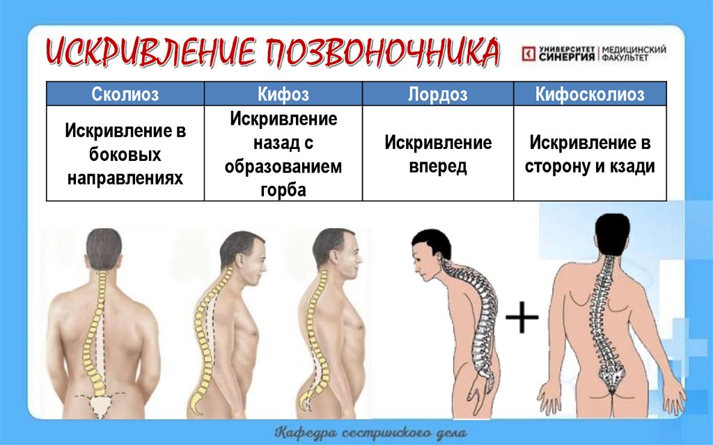 ИСКРИВЛЕНИЕ ПОЗВОНОЧНИКА