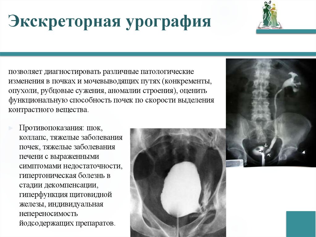 Экскреторная урография