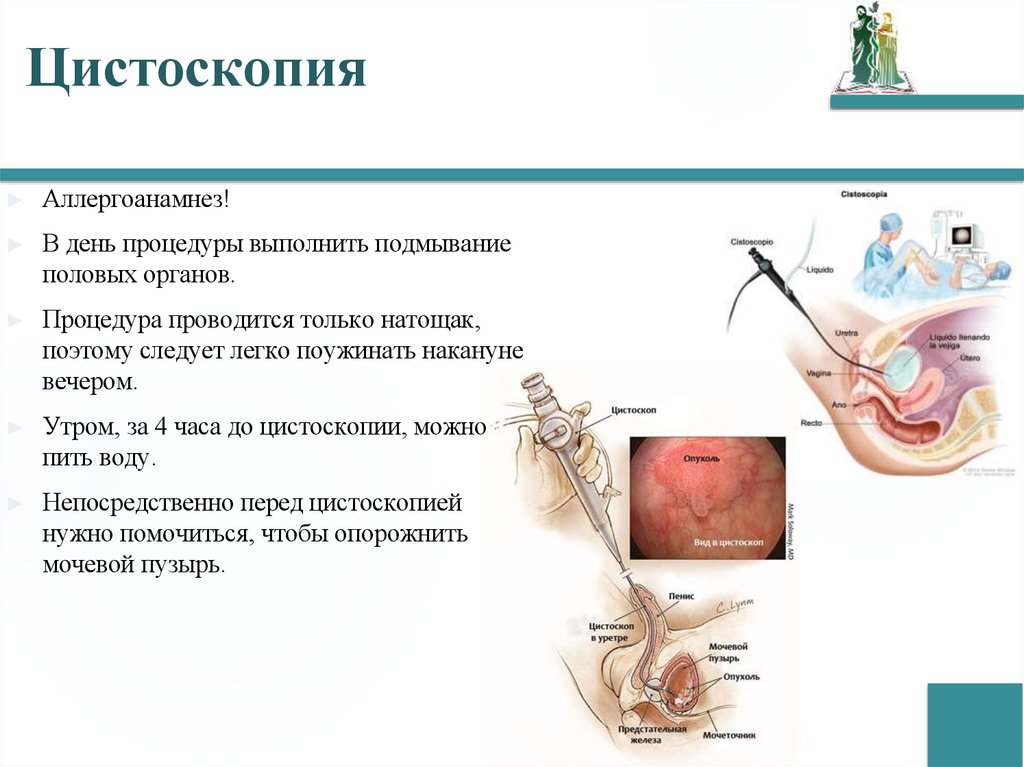 Цистоскопия