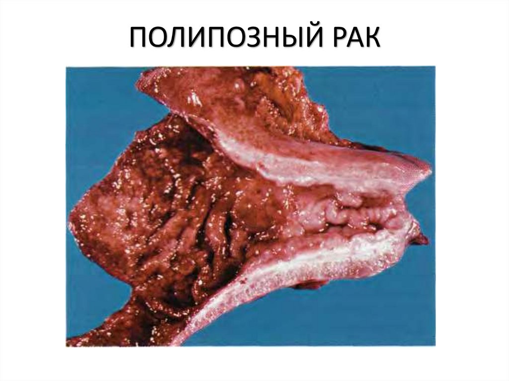 ПОЛИПОЗНЫЙ РАК