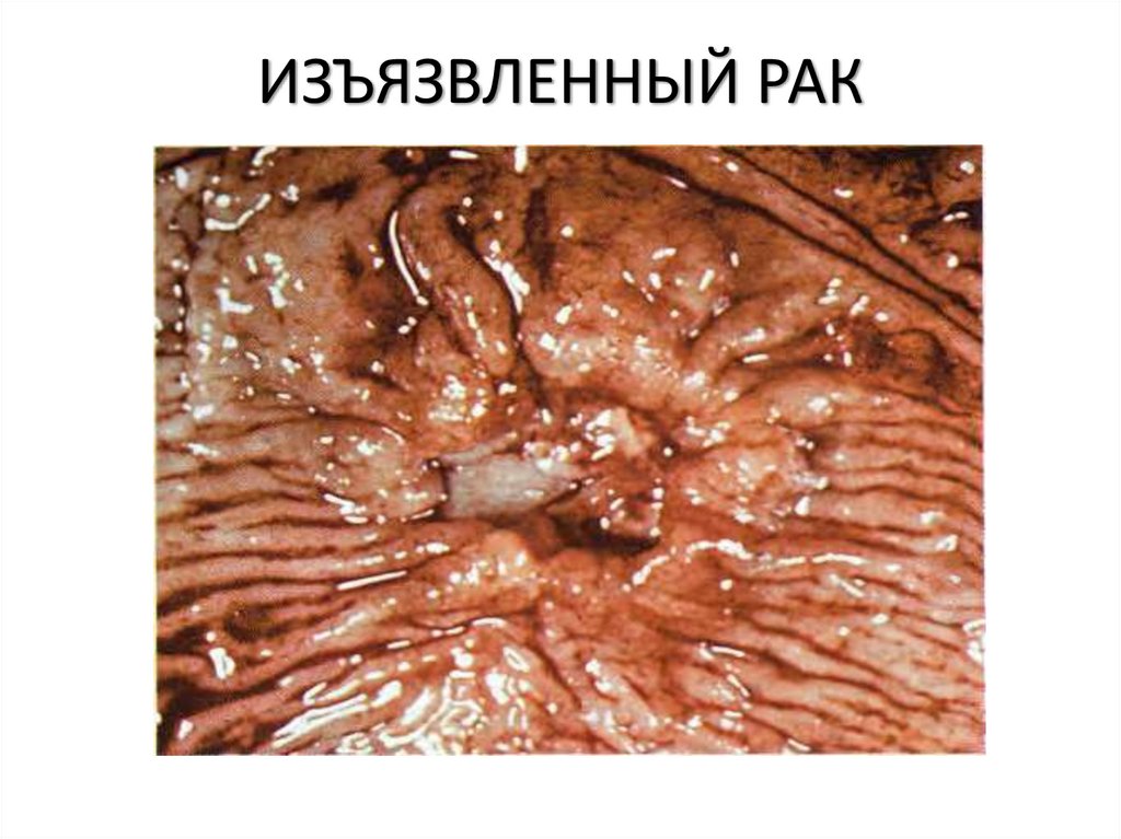ИЗЪЯЗВЛЕННЫЙ РАК