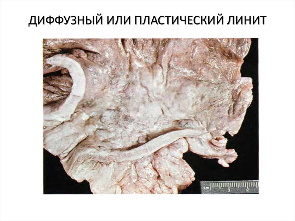 ДИФФУЗНЫЙ ИЛИ ПЛАСТИЧЕСКИЙ ЛИНИТ