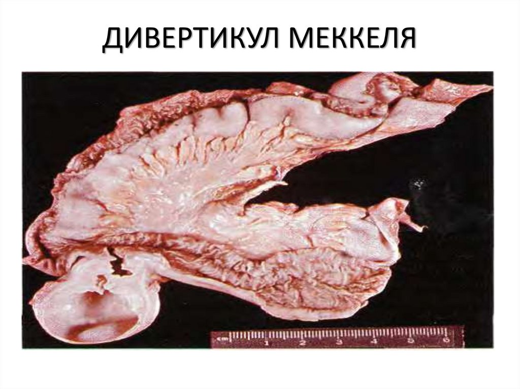 ДИВЕРТИКУЛ МЕККЕЛЯ