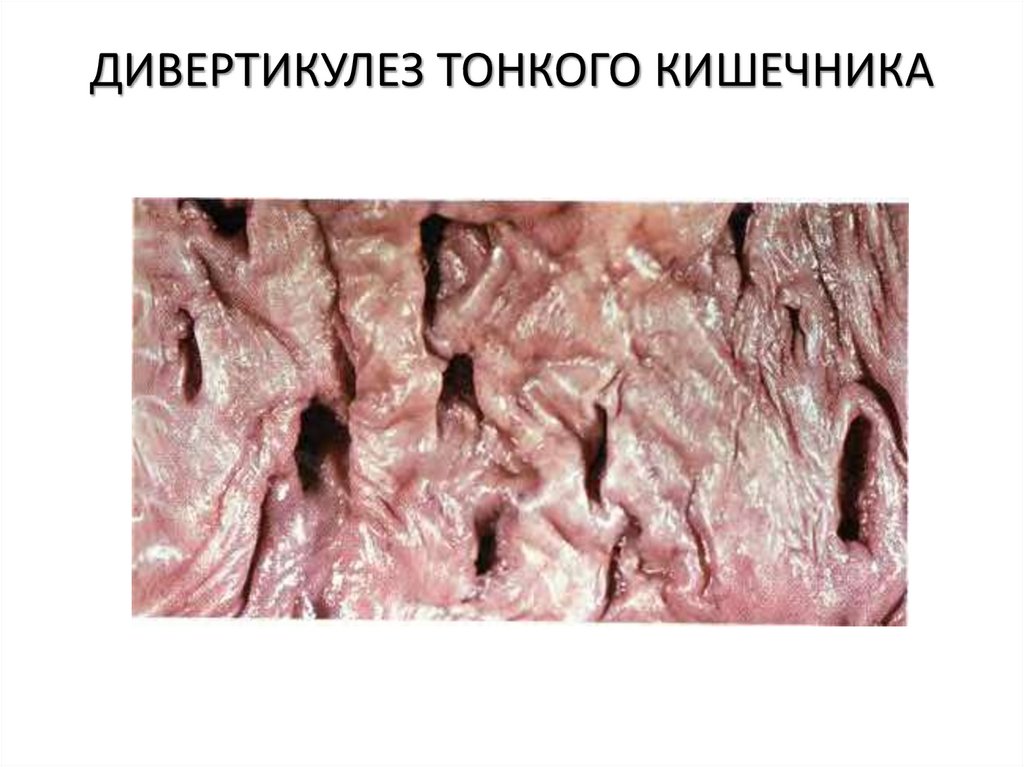 ДИВЕРТИКУЛЕЗ ТОНКОГО КИШЕЧНИКА