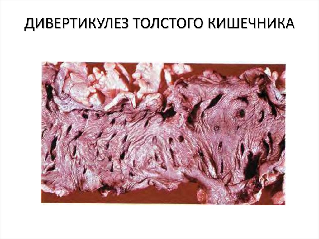ДИВЕРТИКУЛЕЗ ТОЛСТОГО КИШЕЧНИКА