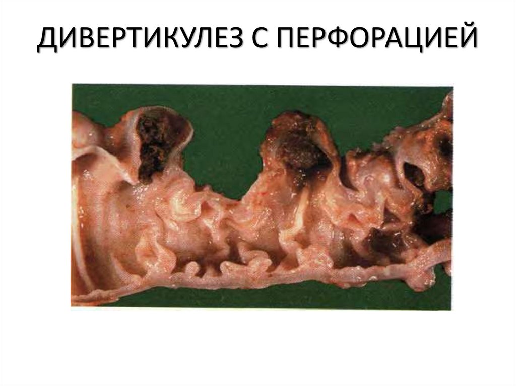 ДИВЕРТИКУЛЕЗ С ПЕРФОРАЦИЕЙ