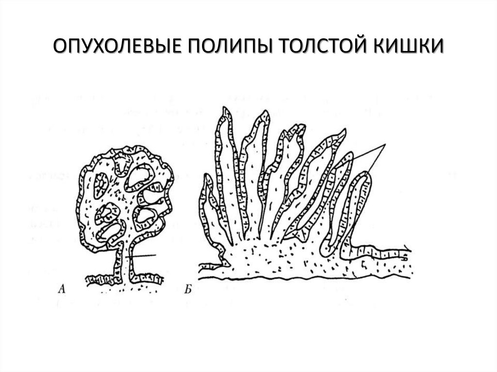 ОПУХОЛЕВЫЕ ПОЛИПЫ ТОЛСТОЙ КИШКИ