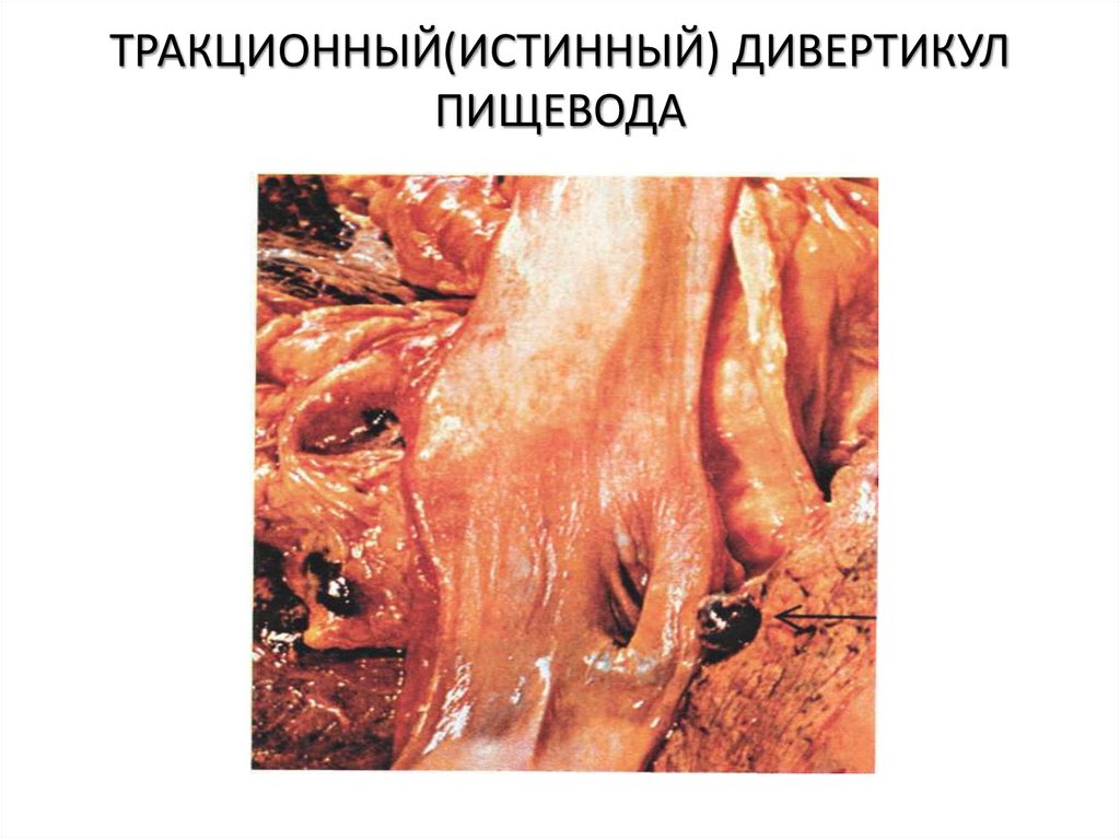 ТРАКЦИОННЫЙ(ИСТИННЫЙ) ДИВЕРТИКУЛ ПИЩЕВОДА