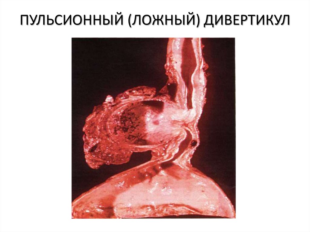 ПУЛЬСИОННЫЙ (ЛОЖНЫЙ) ДИВЕРТИКУЛ
