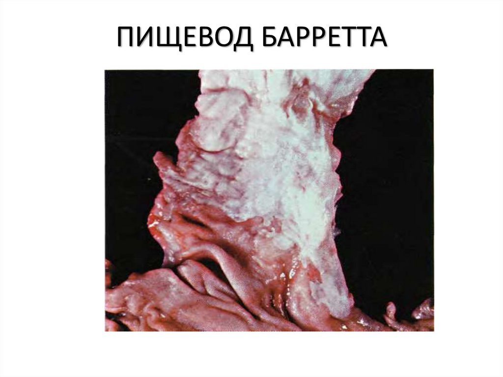 ПИЩЕВОД БАРРЕТТА