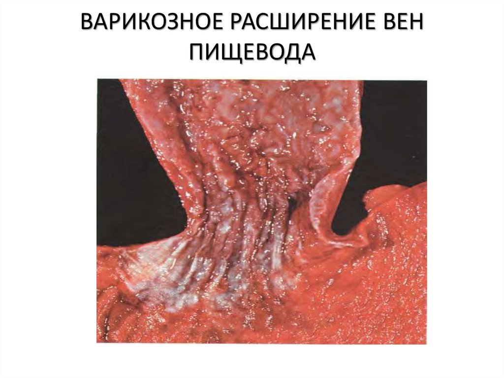ВАРИКОЗНОЕ РАСШИРЕНИЕ ВЕН ПИЩЕВОДА