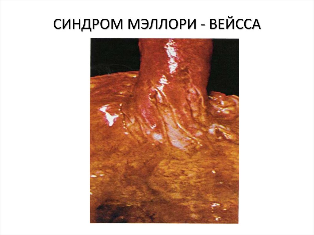 СИНДРОМ МЭЛЛОРИ - ВЕЙССА