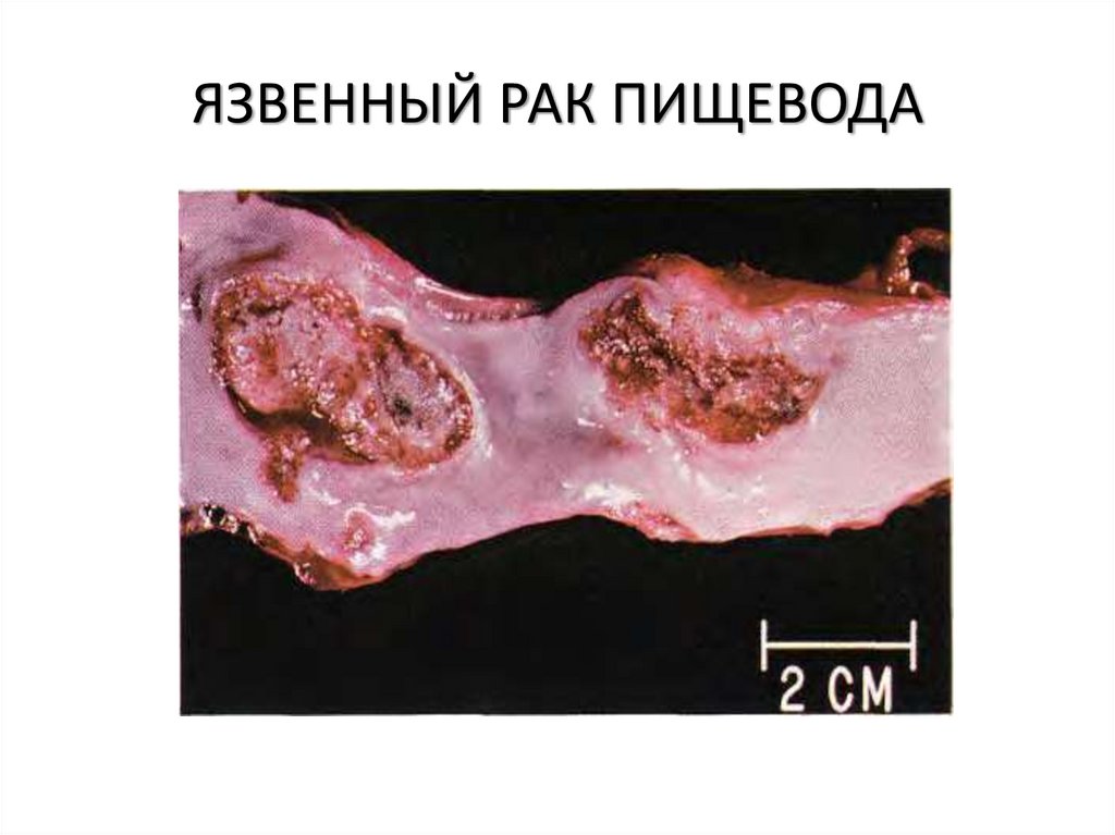 ЯЗВЕННЫЙ РАК ПИЩЕВОДА