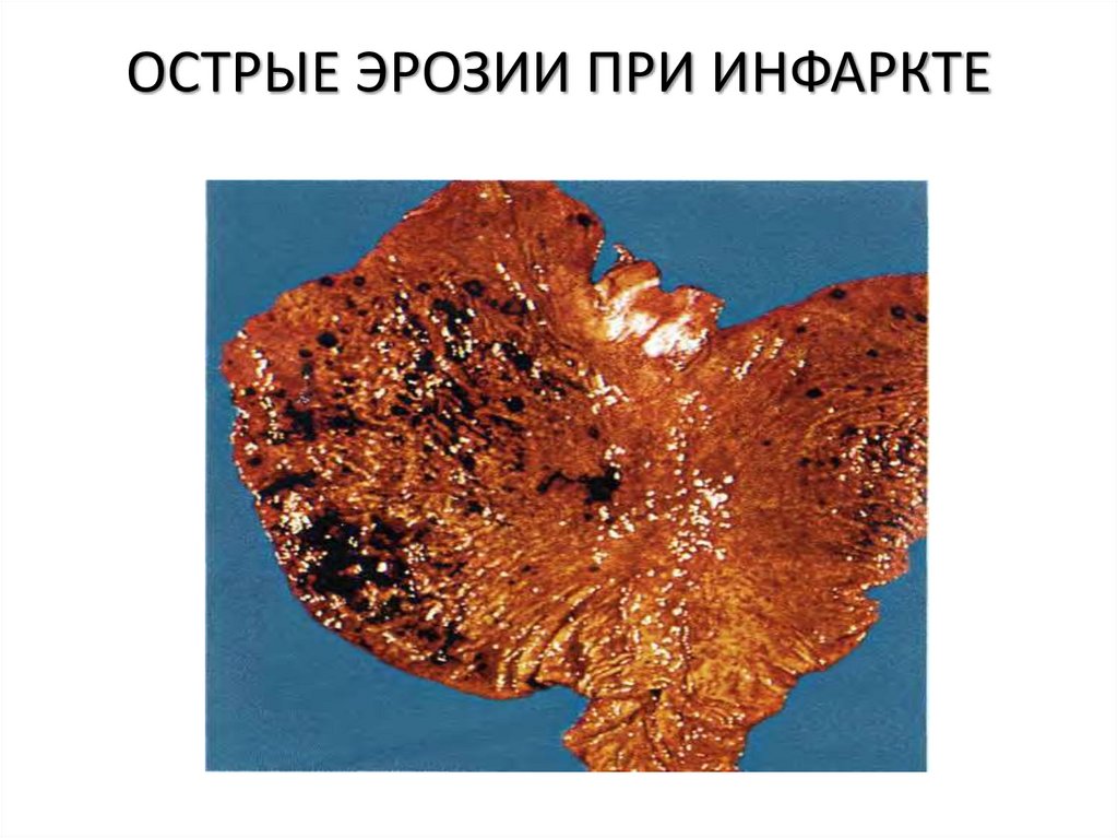 ОСТРЫЕ ЭРОЗИИ ПРИ ИНФАРКТЕ
