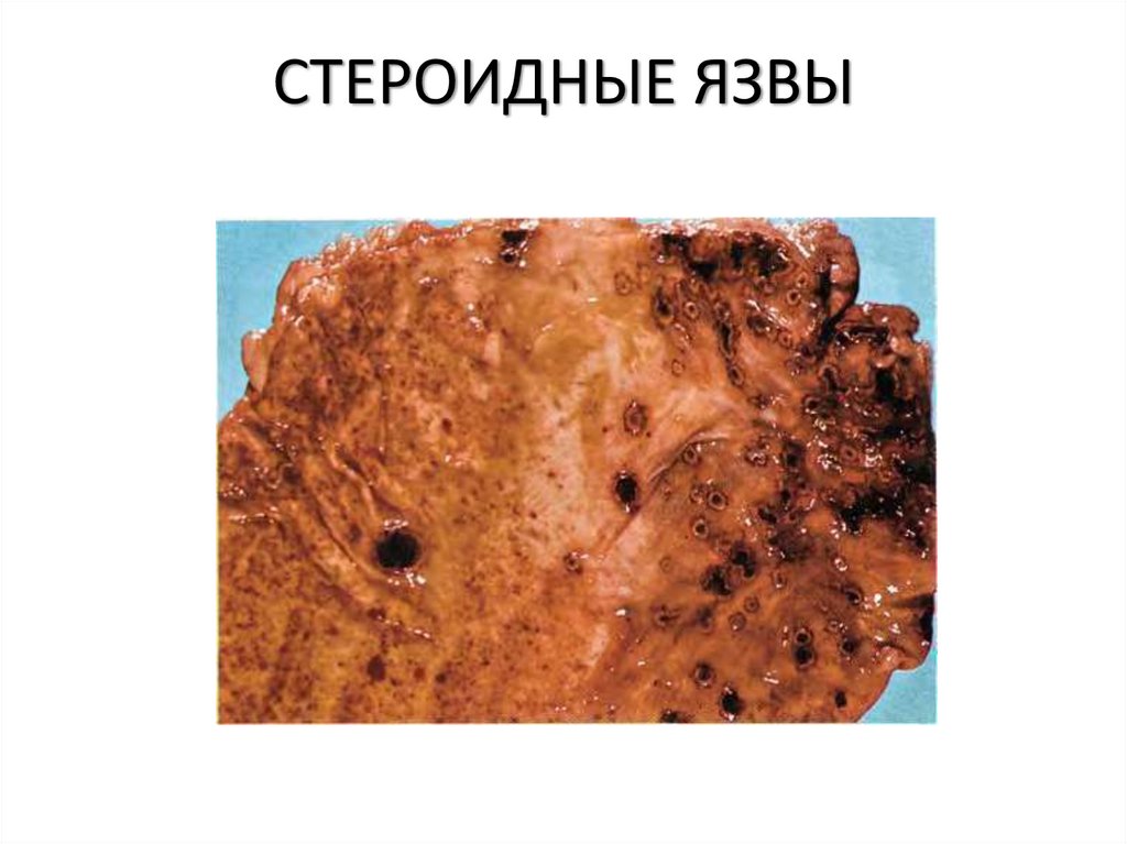 СТЕРОИДНЫЕ ЯЗВЫ