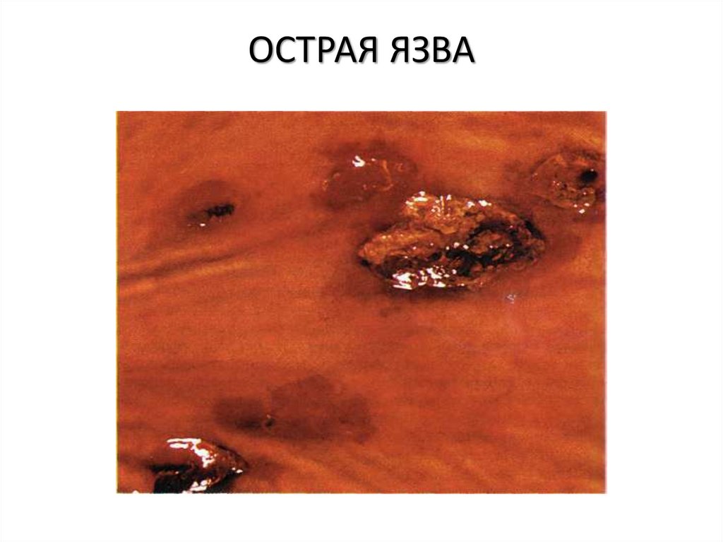 ОСТРАЯ ЯЗВА