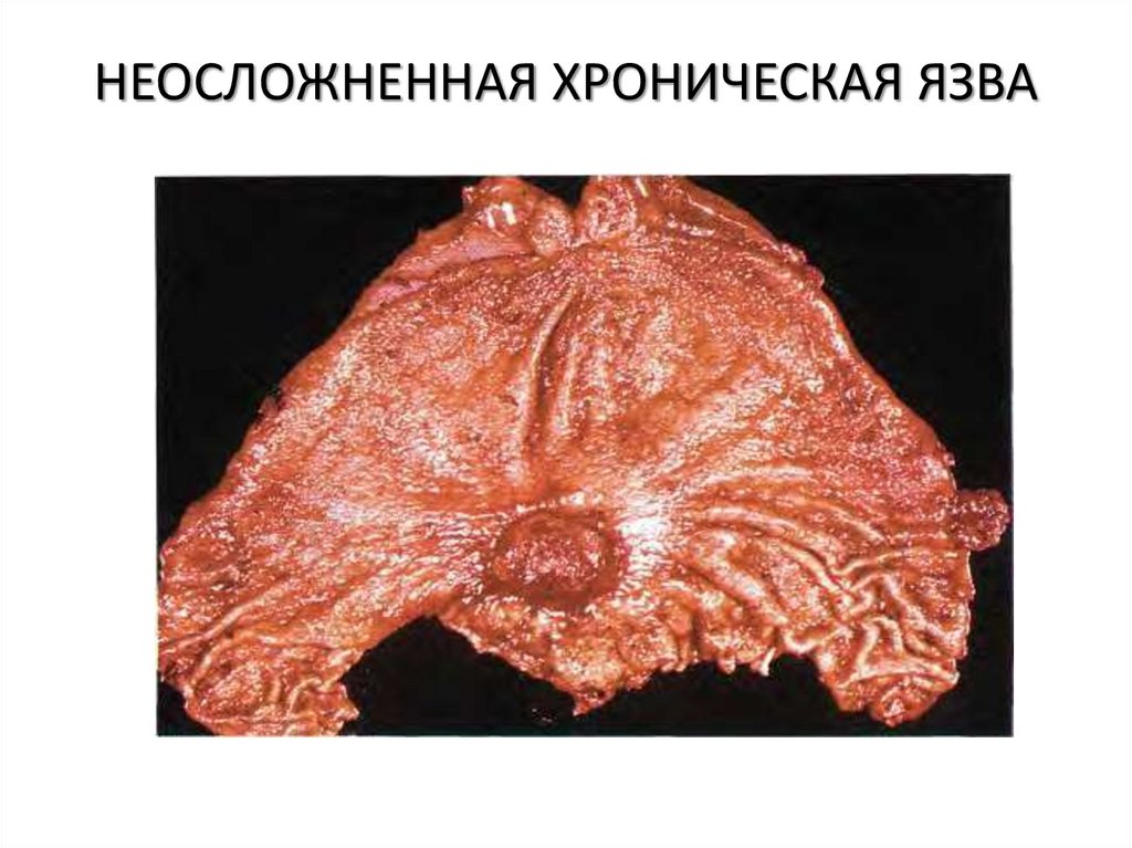 НЕОСЛОЖНЕННАЯ ХРОНИЧЕСКАЯ ЯЗВА