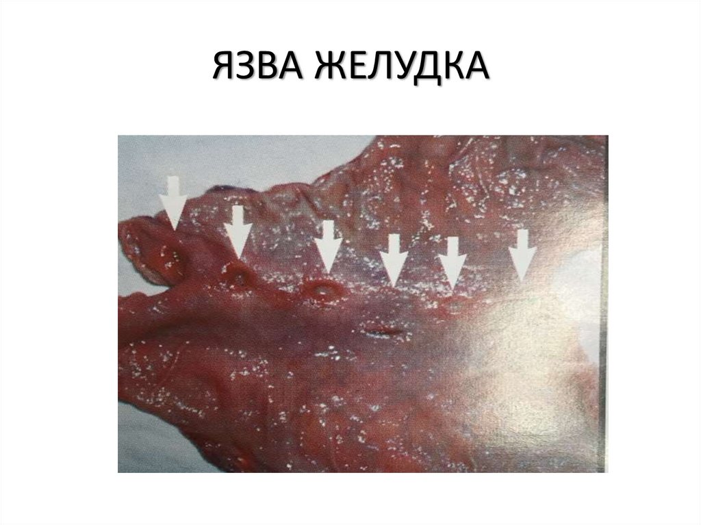 ЯЗВА ЖЕЛУДКА