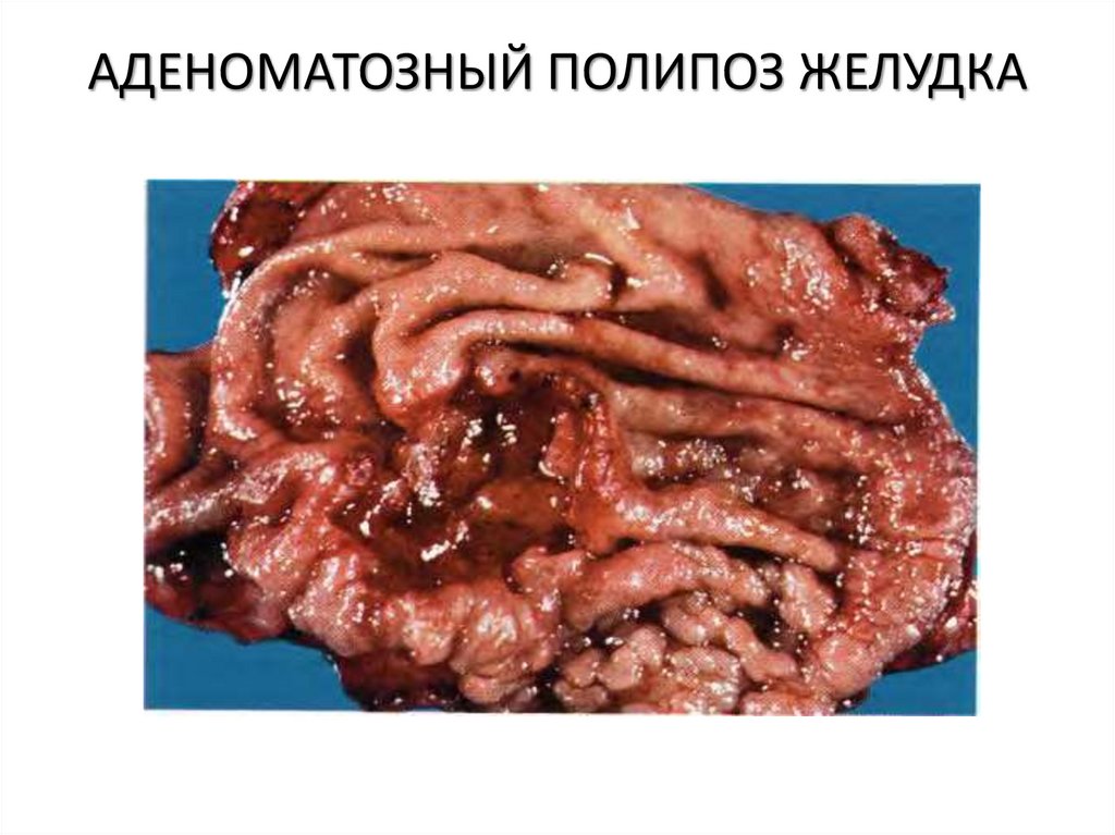 АДЕНОМАТОЗНЫЙ ПОЛИПОЗ ЖЕЛУДКА