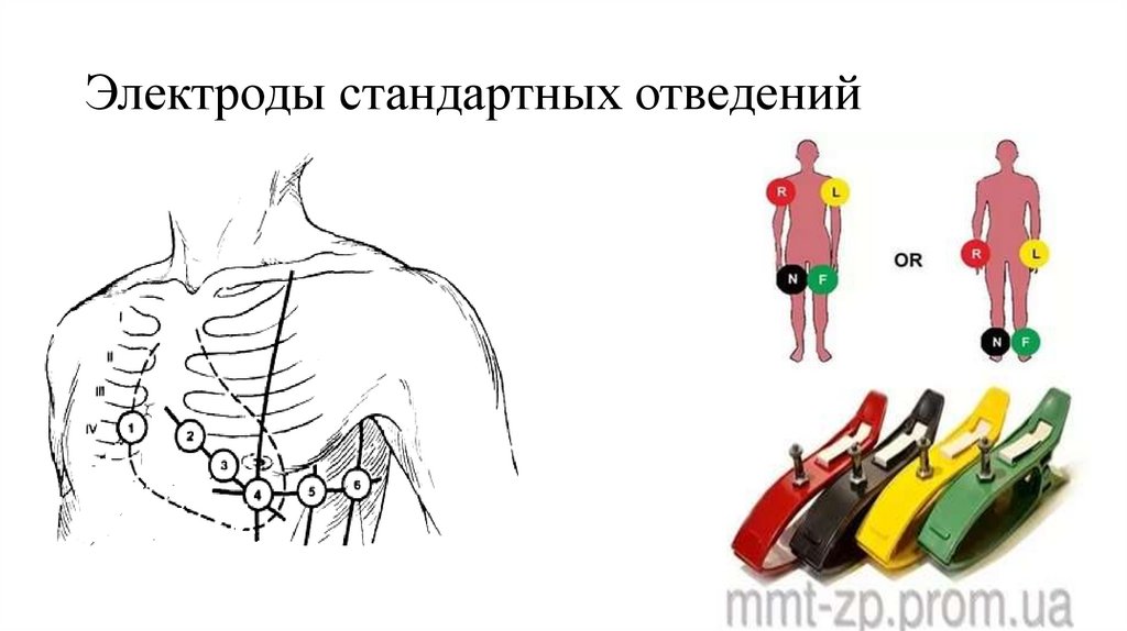 Электроды стандартных отведений