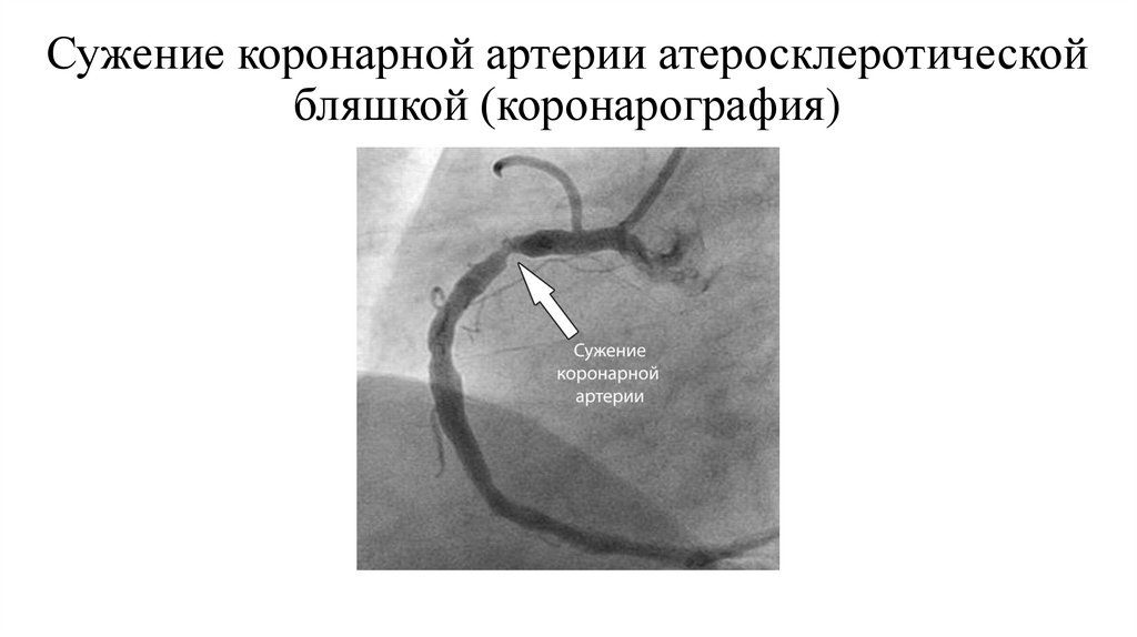 Сужение коронарной артерии атеросклеротической бляшкой (коронарография)