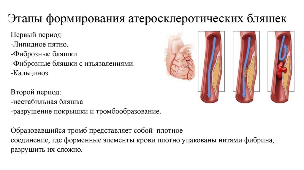 Этапы формирования атеросклеротических бляшек