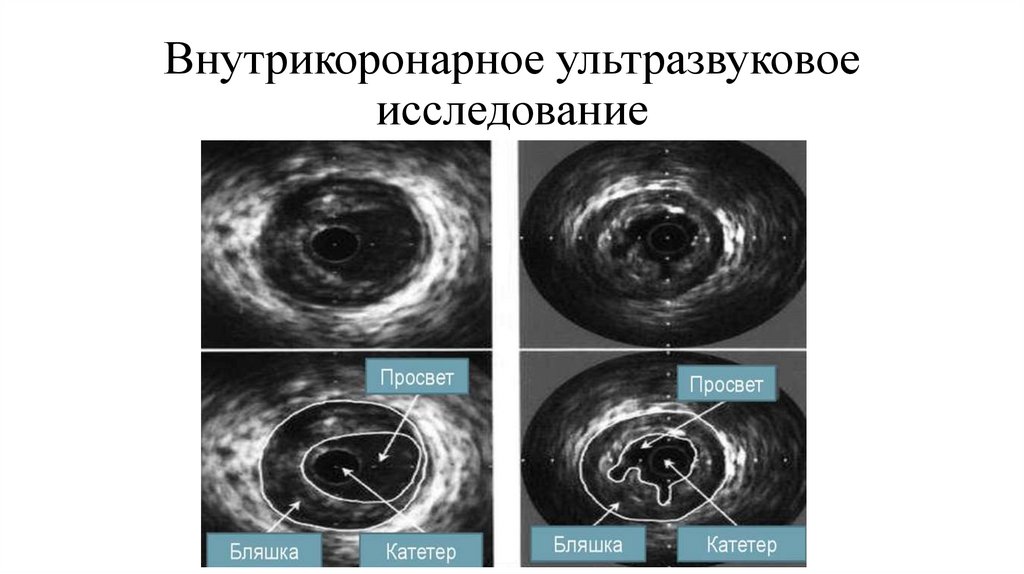 Внутрикоронарное ультразвуковое исследование
