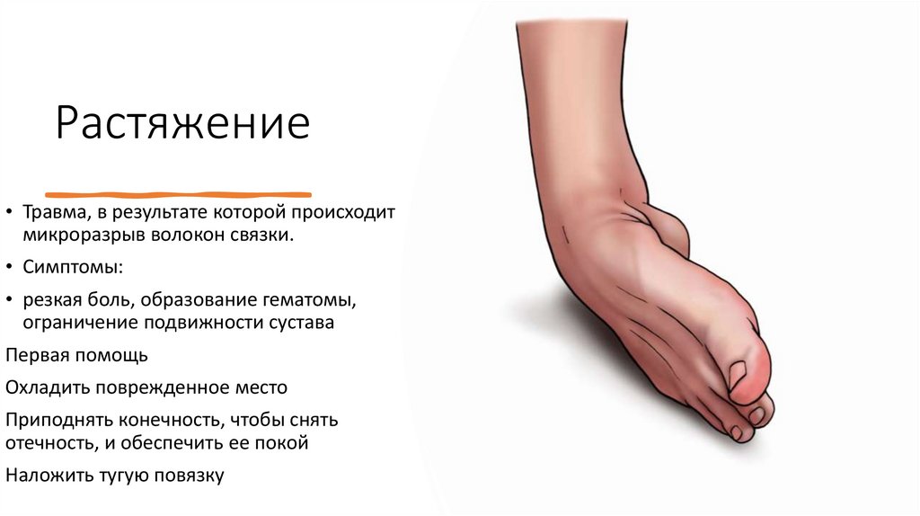 Растяжение