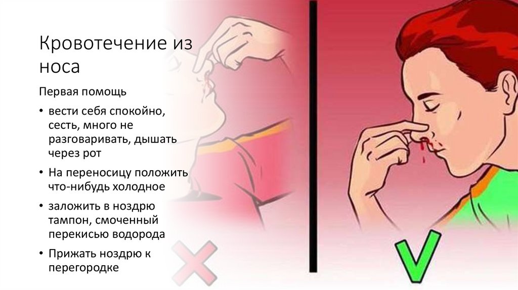 Кровотечение из носа