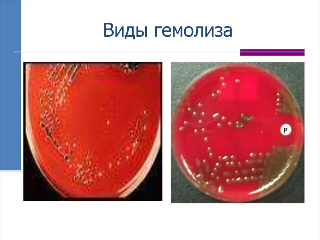 Виды гемолиза