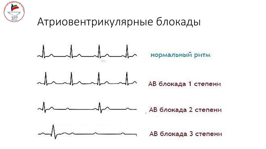 Атриовентрикулярные блокады