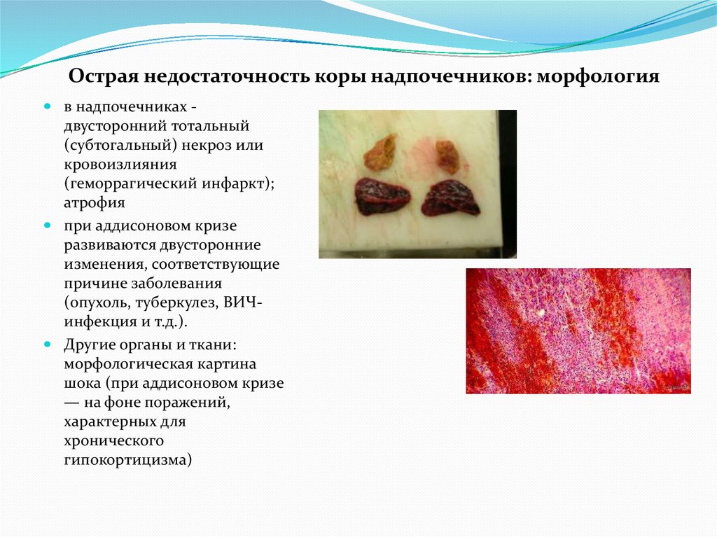 Острая недостаточность коры надпочечников: морфология