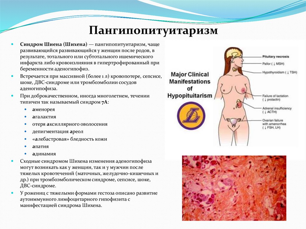 Пангипопитуитаризм