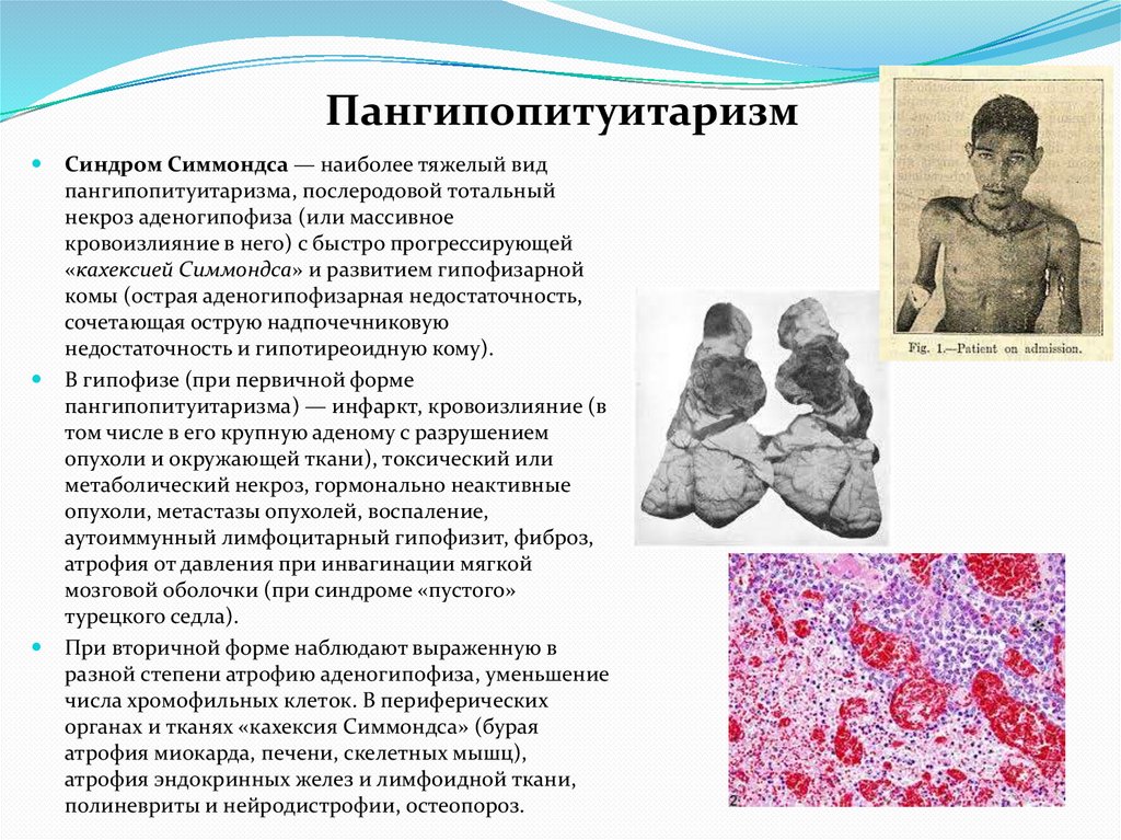 Пангипопитуитаризм