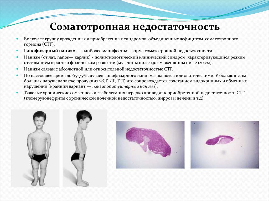 Соматотропная недостаточность