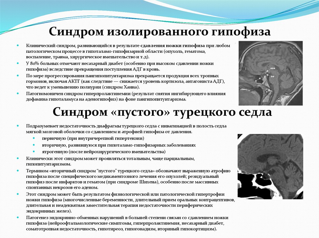 Синдром изолированного гипофиза