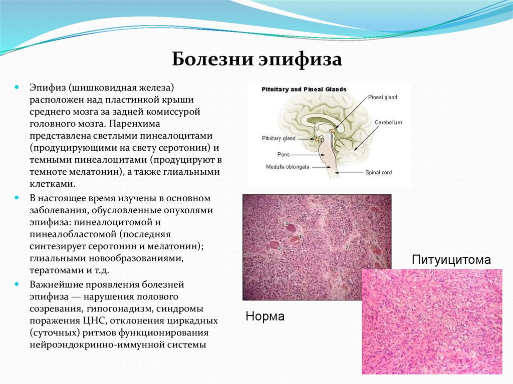 Болезни эпифиза