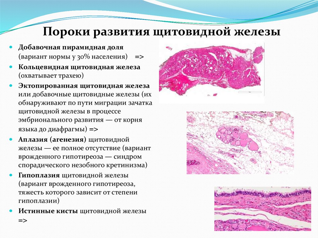 Пороки развития щитовидной железы