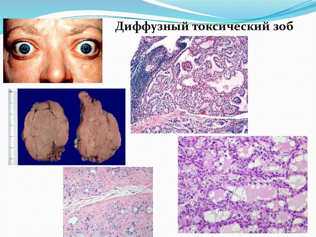 Диффузный токсический зоб
