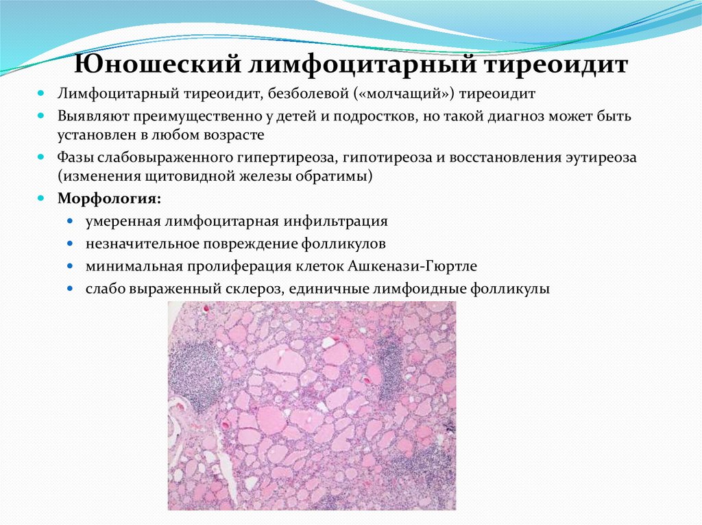 Юношеский лимфоцитарный тиреоидит