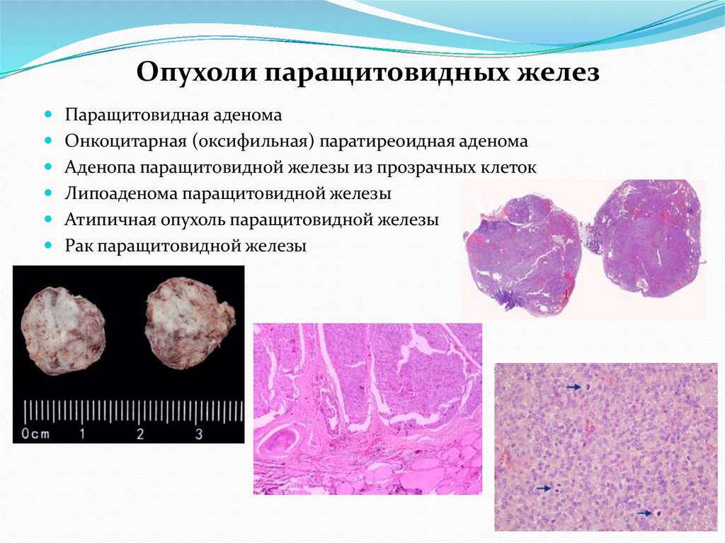 Опухоли паращитовидных желез