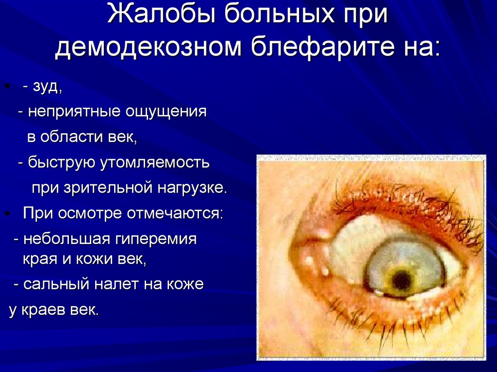 Жалобы больных при демодекозном блефарите на: