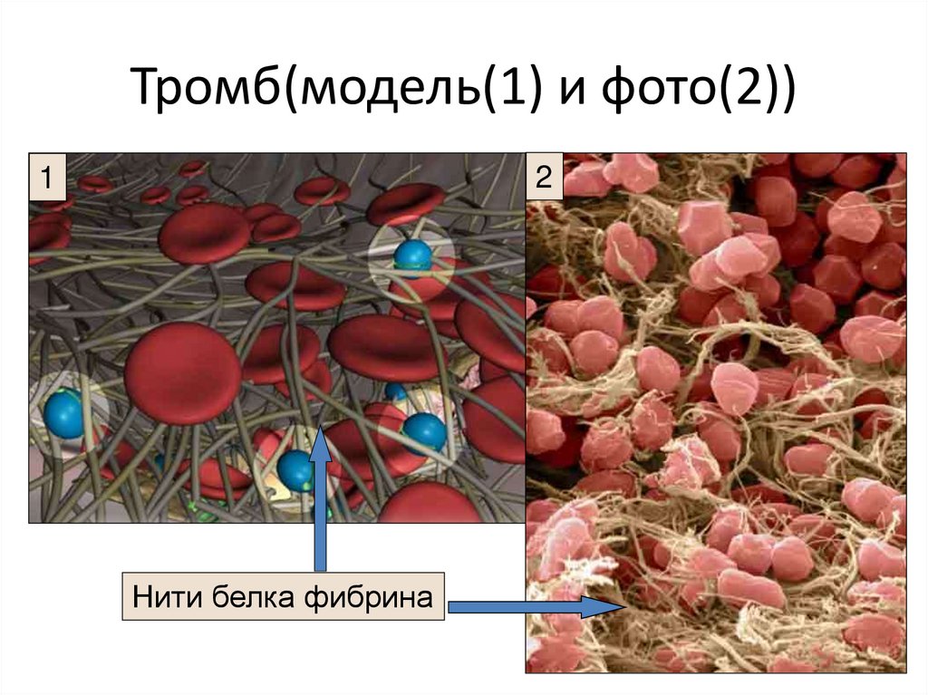 Тромб(модель(1) и фото(2))