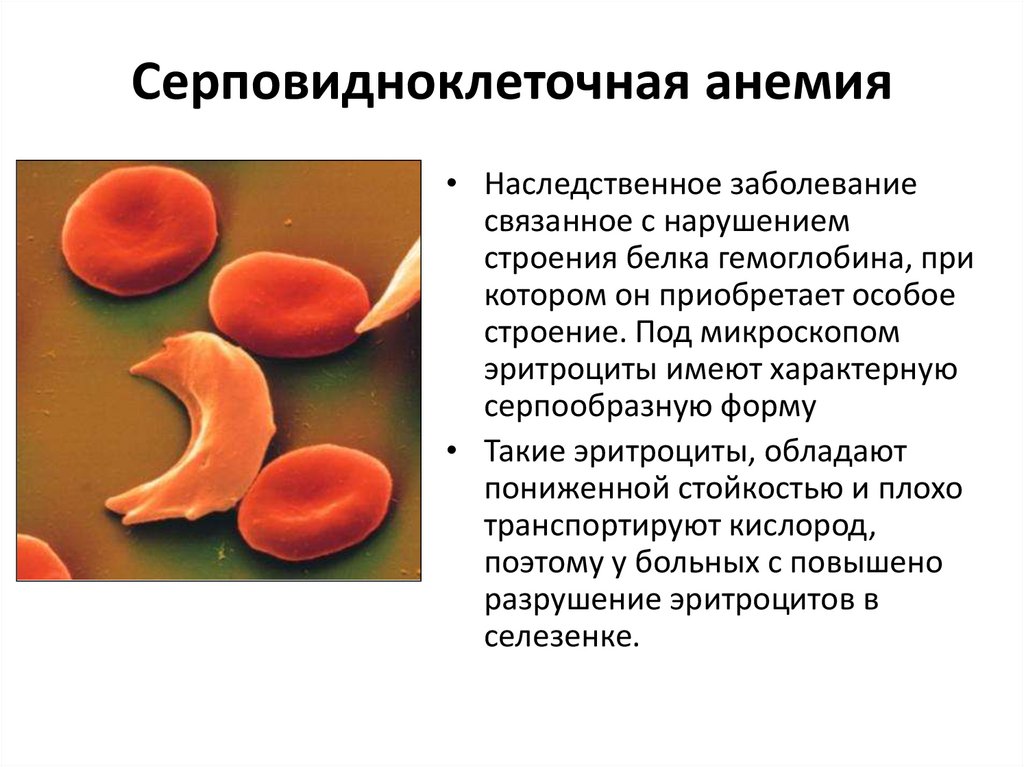 Серповидноклеточная анемия