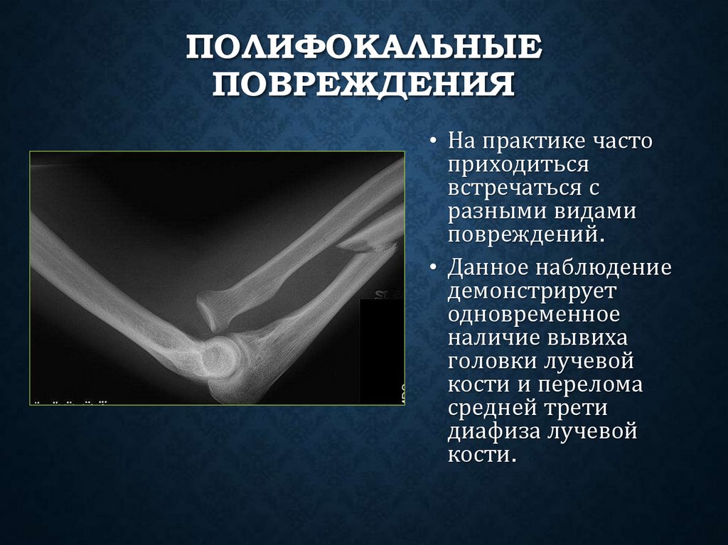 Полифокальные повреждения