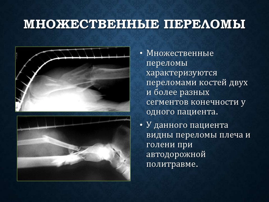 Множественные переломы