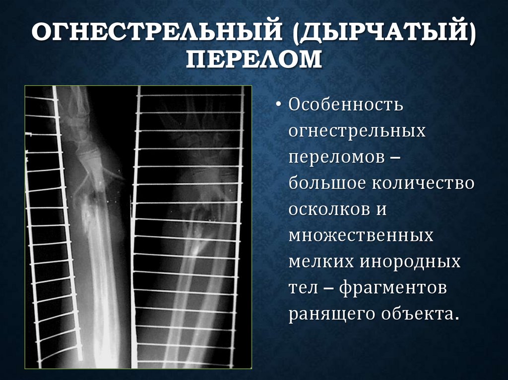 Огнестрельный (дырчатый) перелом